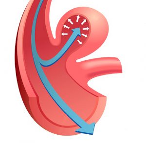 Операция на сердце в Израиле